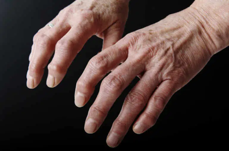 Comment soulager l’arthrose naturellement ?