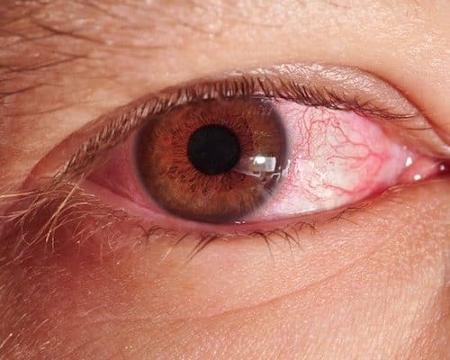 Pourquoi mes larmes me brûlent les yeux ?