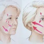lifting cervico facial